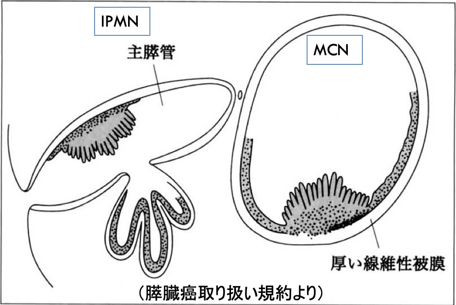 （訳ありセール 格安） 膵嚢胞 〜IPMNを中心に〜 | 胆膵ノート 医学一般